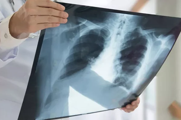 Akciğer Tomografisi