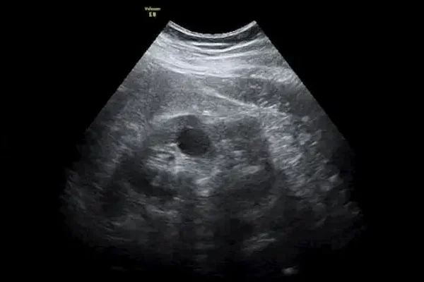 Renal Ultrason