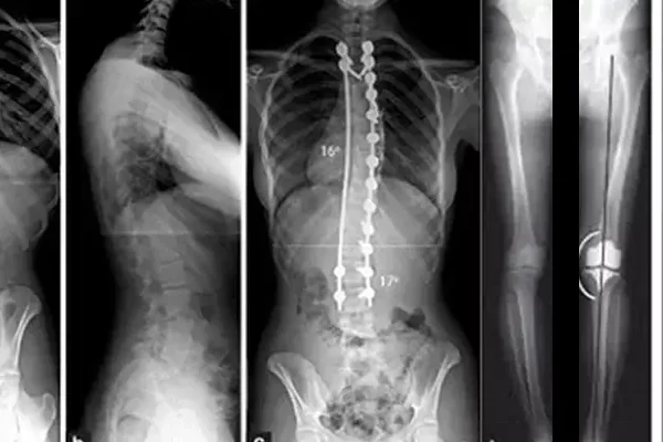 Skrotal Ultrasonografi