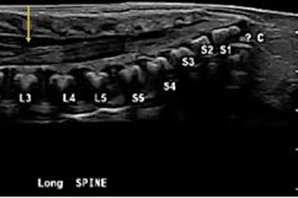 Spinal Ultrasonografi